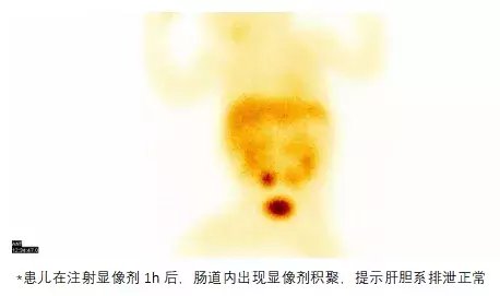 胆道|患儿持续黄疸，核医学无创检查助力探究病因