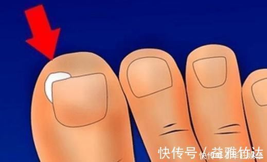 遗传病|脚指甲长进肉里教你一个“土办法”治疗,不用看医生