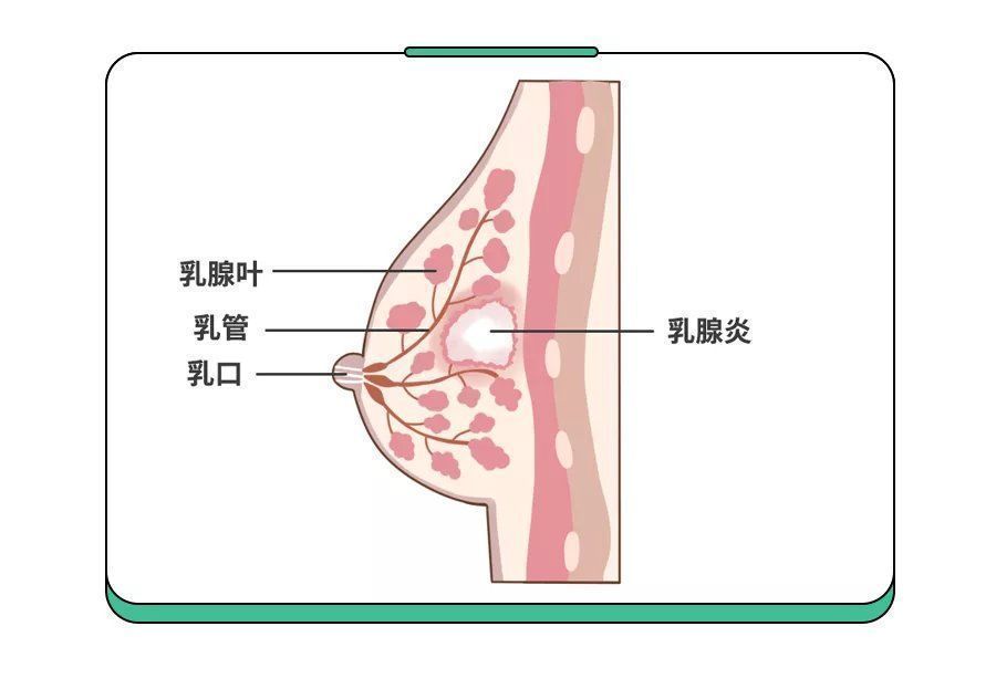 乳头|比生娃还痛!遭遇哺乳期乳腺炎,用这4招少受80%的罪