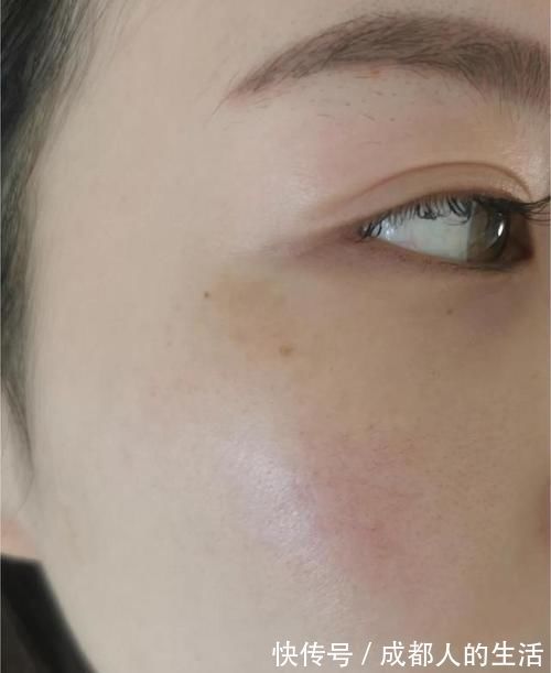 维生素e|长黄褐斑的人，经常补充3种维生素，清除黑色素，或能淡斑成功