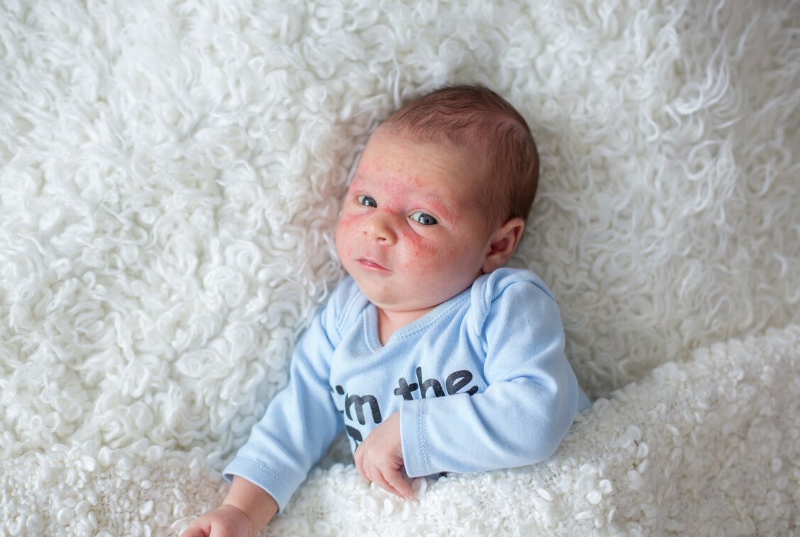 皮肤状态|孕晚期易积“胎毒”,影响宝宝颜值,身体给出的信号孕妈需注意