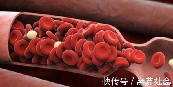 专家|血管堵塞导致血栓,专家每天坚持做两个动作,全身血液通畅