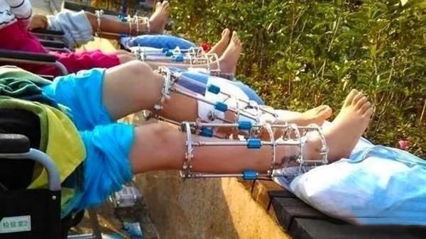 孩子|男孩为当飞行员花16万断骨增高,多年后,因“长高”毁掉人生