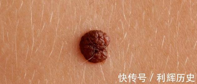 疼痛|注意,癌症早期有这些症状,早发现、早诊断、早治疗,提高治愈率