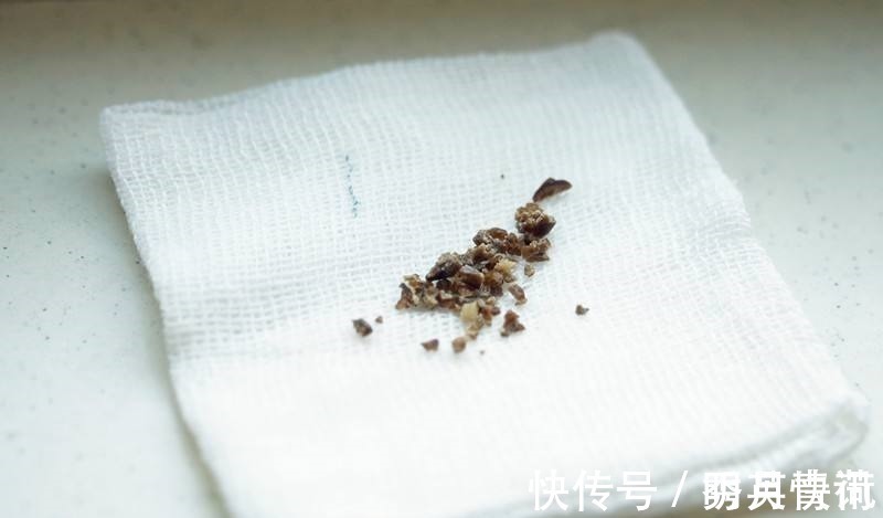 结石|气通了,结石就掉下来了!老中医拿出一张方子,说明一切