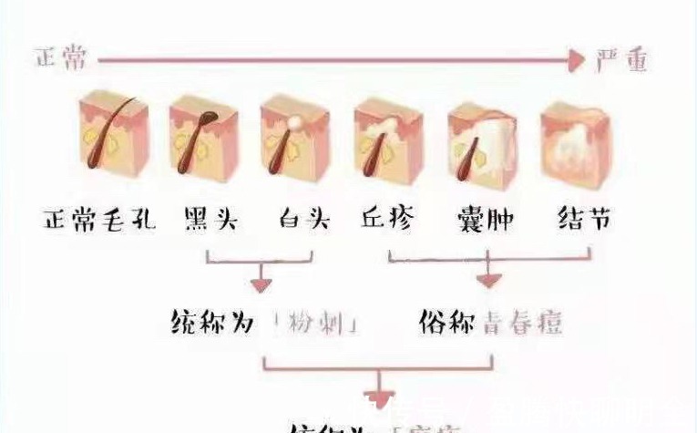饮食习惯|男士护肤：皮肤长痘应该怎么护肤？