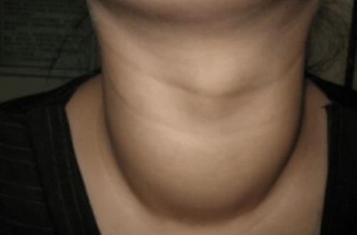 粗粮|多家医院联合声明:停止食用“1粗粮”,比烟酒还毁甲状腺,赶紧扔