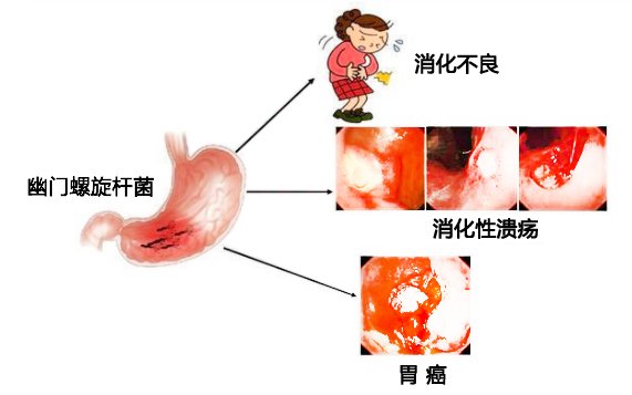 幽门螺旋杆菌|【科普】什么是幽门螺杆菌？幽门螺旋杆菌的传播途径有哪些？