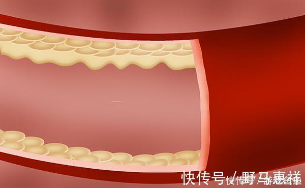 贫血|血压高压和低压相差多少正常？哪些原因会导致压差过大？医生解答