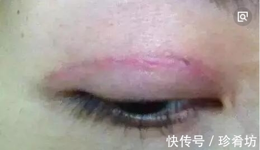 双眼皮 手术割了双眼皮的人,老了之后有什么影响?看完真要留意了