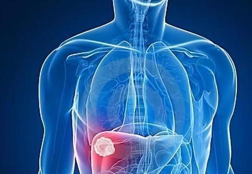 结节|如何让你的肺结节变小甚至消失?听听医生怎么说