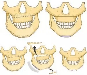 乳牙|家长必读权威专家提醒:必须在12岁前处理的10种儿童牙颌畸形