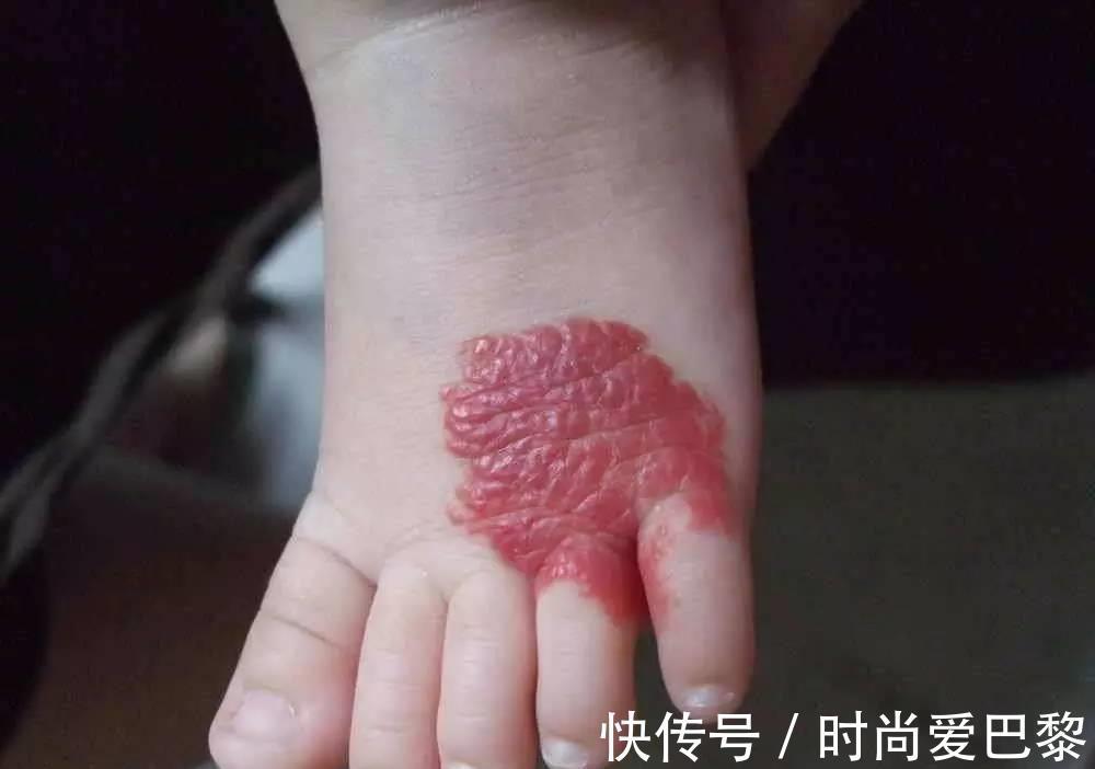 胎记|40%宝宝胎记不是来自遗传,更多是因为孕妈,孕期太放纵四个行为