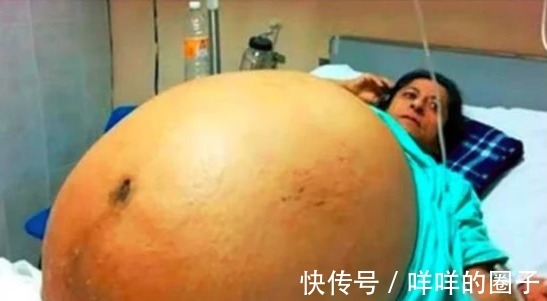 足球队|孕妇肚子这么大？一胎生了一个足球队！十多个医生一块接生！