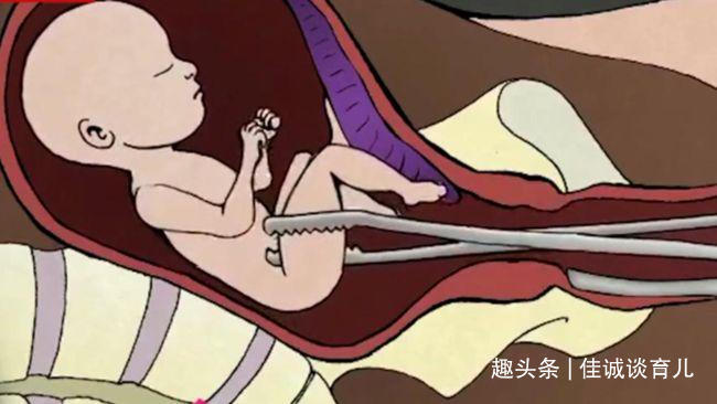 手术|为啥医生建议不要打掉头胎,其中有很大的科学道理,你应该知道