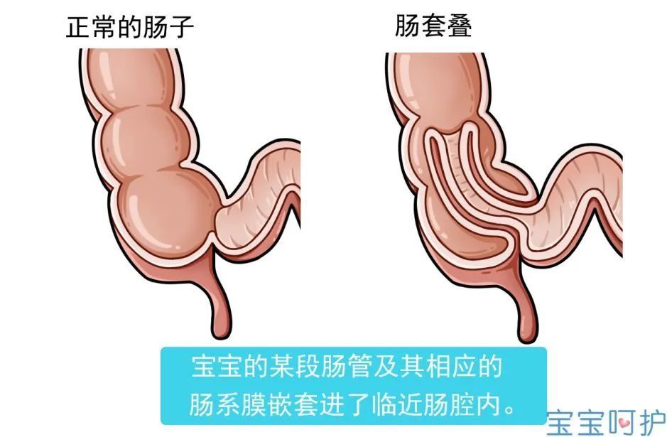 药物|心痛!7月龄宝宝灌肠后死亡,一生病就灌肠,真的就是在害他!