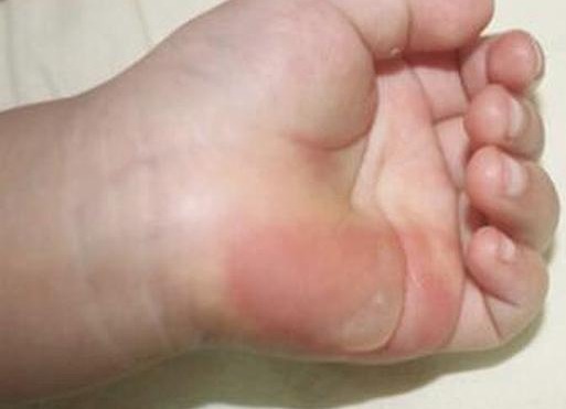 凉水|5岁孙子被开水烫伤,奶奶临危不乱及时处理,获医生称赞 !