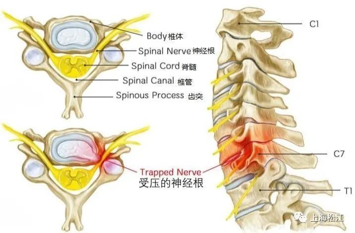 颈椎病患者|肩痛、手麻，是颈椎病？不一定！来看解答→