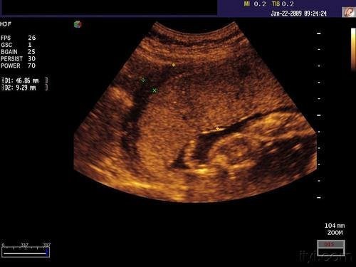 判断|胎盘是否老化怎么判断？关系胎儿发育的关键，孕妈不可大意