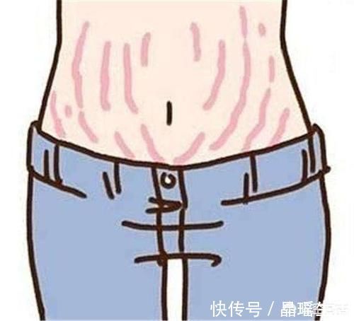 妈妈们|妊娠纹一般是在怀孕几个月时长的?如何避免妊娠纹出现?