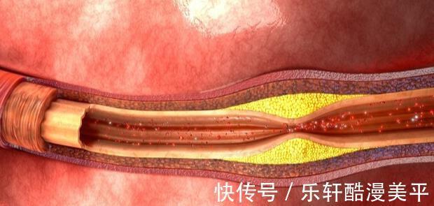 肥肉|血管“軟化劑”已公布，芹菜榜上無名，此物若愛吃，血管干干凈凈