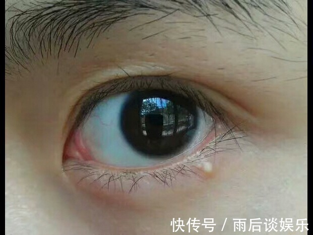 毛周角化|眼睛周围有脂肪粒怎么办?