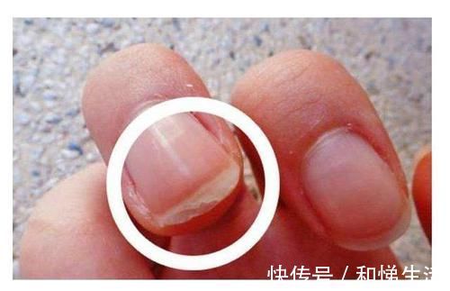指甲|手上出现这9个表现,可能是体内疾病发出的求救信号,别不当回事!