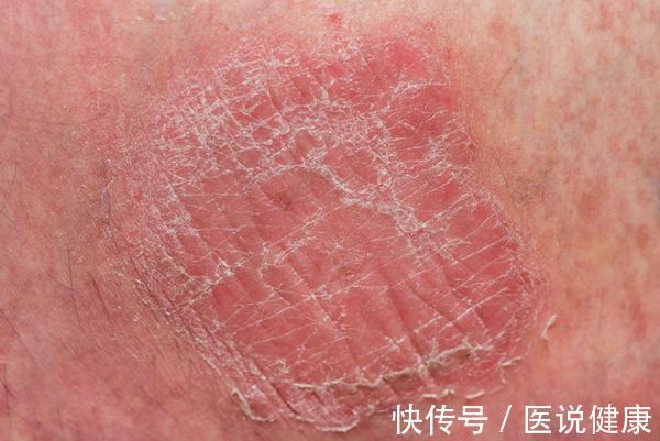 皮肤|糖尿病患者,可能会出现6种皮肤病变,发现后,及时控制血糖