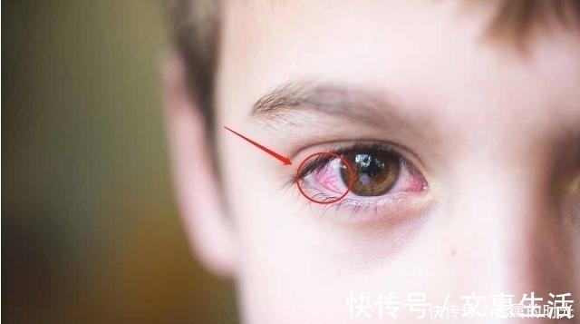 发红|肝受损，人体会有“3红1热”，若有，要学会养肝了