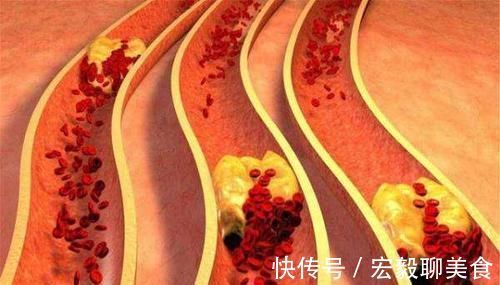 检查|长期服用他汀类降脂药,要定期去医院做这4个检查,很重要