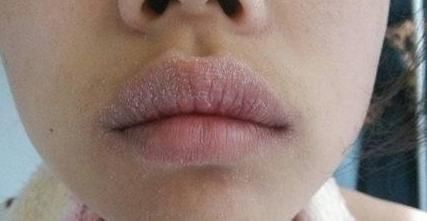 嘴唇|嘴巴上出现死皮,一撕一长条钻心疼?4种病作祟,看完立马停手