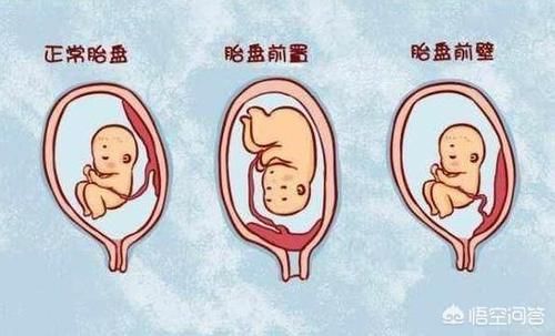 怀孕胎儿位置在前壁后壁有什么不同吗？