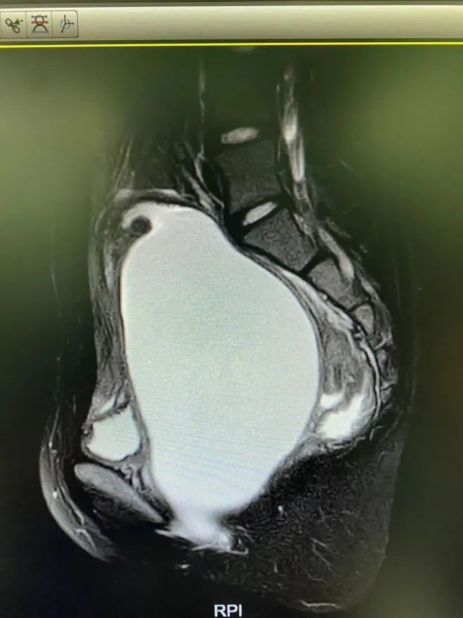 肚子疼|13岁女孩肚子疼想忍一忍,结果“忍”出一袋血
