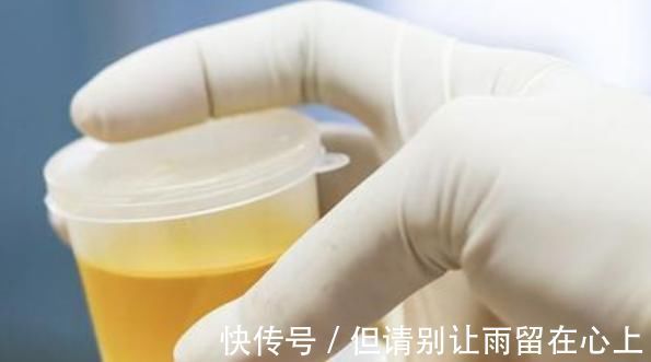 尿道梗阻|小便时出现2个表现，可能是膀胱癌发出的信号！2个方法可预防！