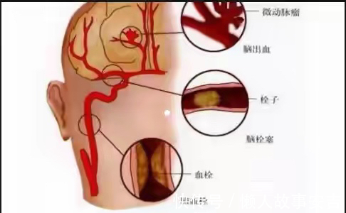 脑梗死|人到中年,如何避免脑梗死,做到三个坚决,让你生活更健康