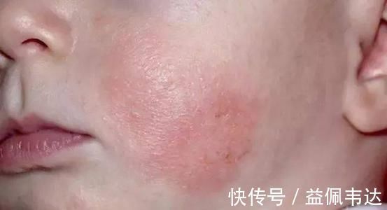 母乳喂养|2个月宝宝脑出血,医生:大脑有损伤,问题出在妈妈的母乳上