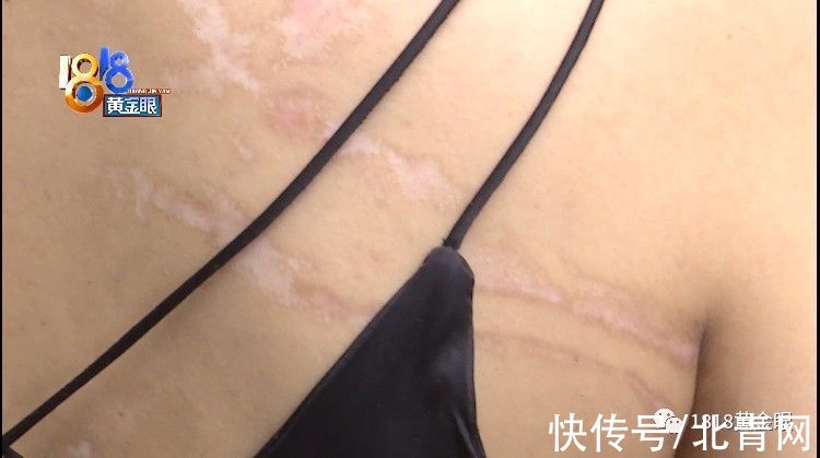 朱老板|姑娘拔火罐，后背起了火
