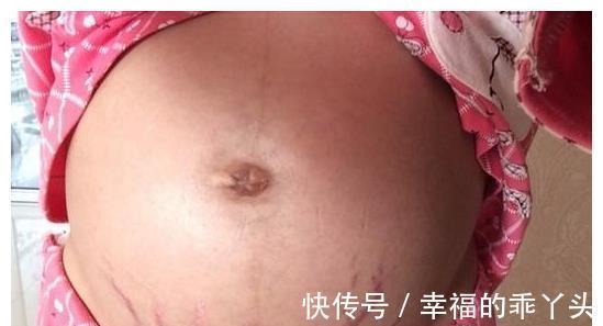 女性|为何同样都是怀孕,有些女性却不会长“妊娠纹”?孕妈要了解