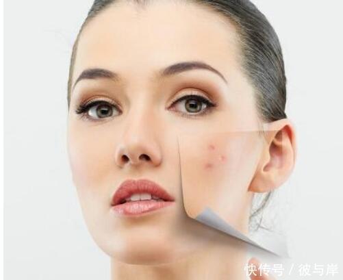 痘印完全消除要多长时间?是否要用激光?这些问题要弄清楚