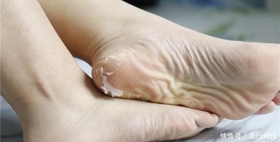 皮肤病|为什么中老年人脚后跟会出现干裂多跟3种疾病有关,别不在意