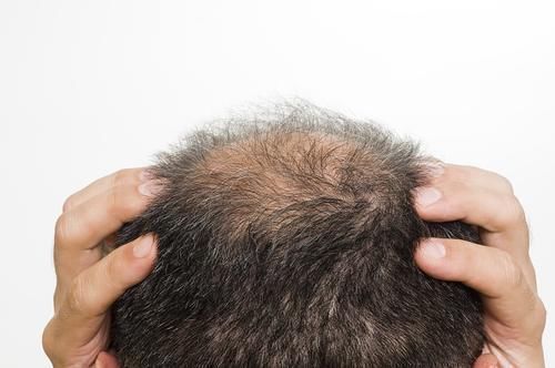 肝病|头部有3个异常，暗示肝硬化，肝病最怕拖，出现一个也要尽早检查