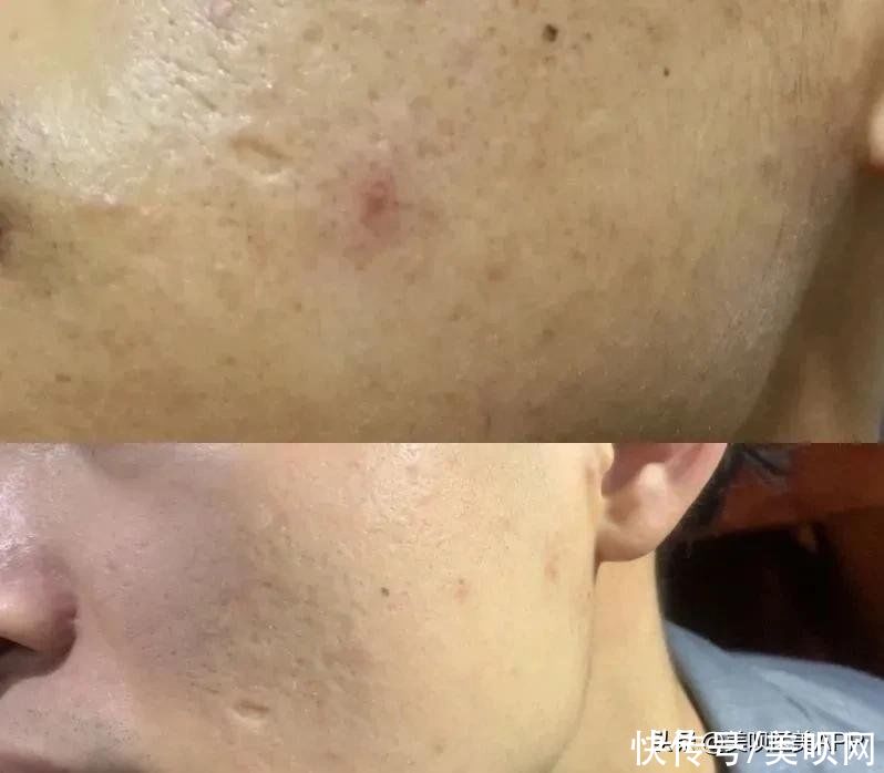 爱豆们竞当医美达人？男性适合的轻医美项目top5合集