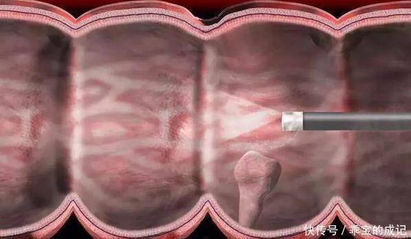 刘医师|四部分的息肉,最好及时切除,癌症可能会出现很长一段时间!