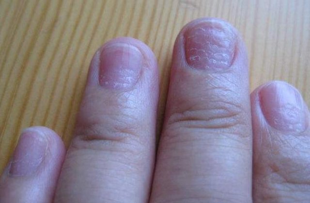 白血病手指甲图片