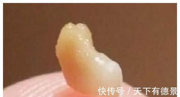 扁桃体结石|孩子因口气臭被同学排挤,送诊查检后,医生都没忍住恶心呕吐