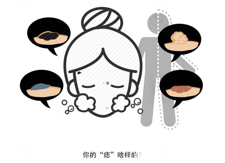 黑痣|身上莫名长出痣,别满不在乎,若是这5种,当心是黑色素瘤