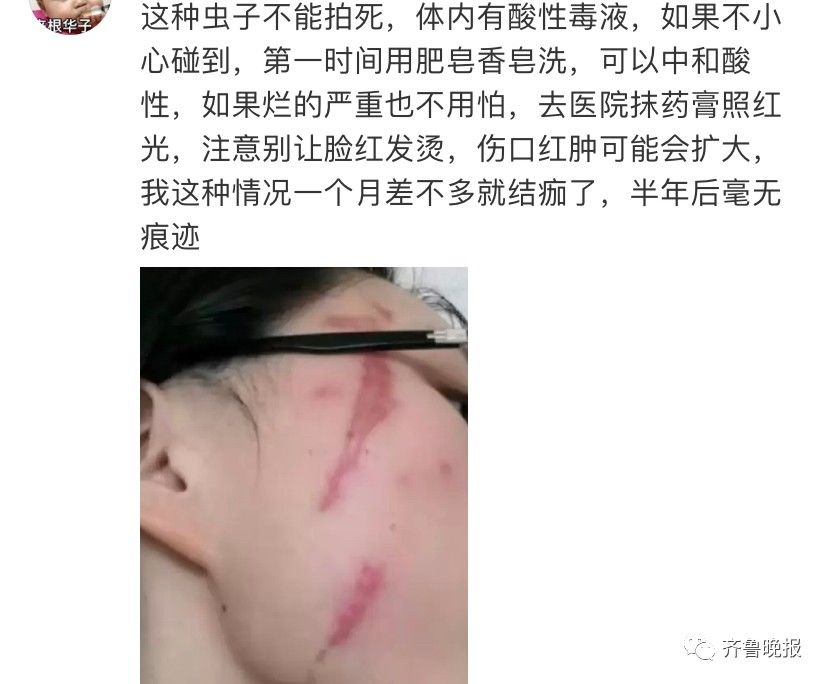 毁容|女子被虫子爬过脸颊险毁容，网友：再也不敢关灯玩手机了