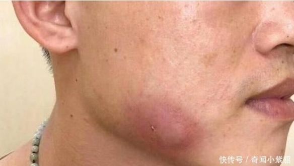 小伙|小伙经常熬夜,脸颊突发的就肿了起来,到了医院检查完让人不淡定
