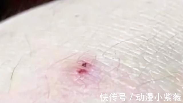 工作细胞|日本小哥沉迷日漫《工作细胞》不可自拔,于是他将伤口二次元化了