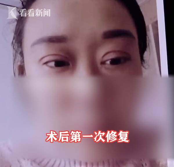 金女士|女子花2万割双眼皮3个月没消肿 老公要离婚